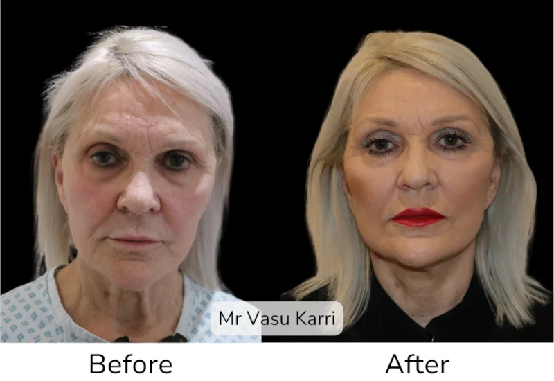 Facelift Patient 15 View 1